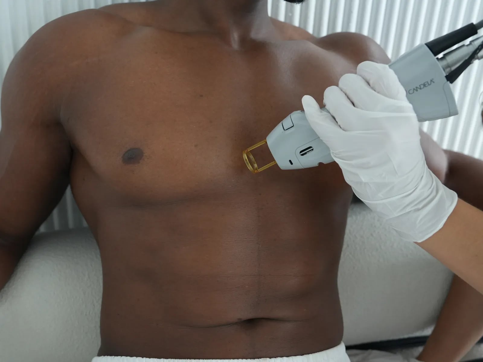 A Semper specialist treating a client's chest with the Candela handpiece