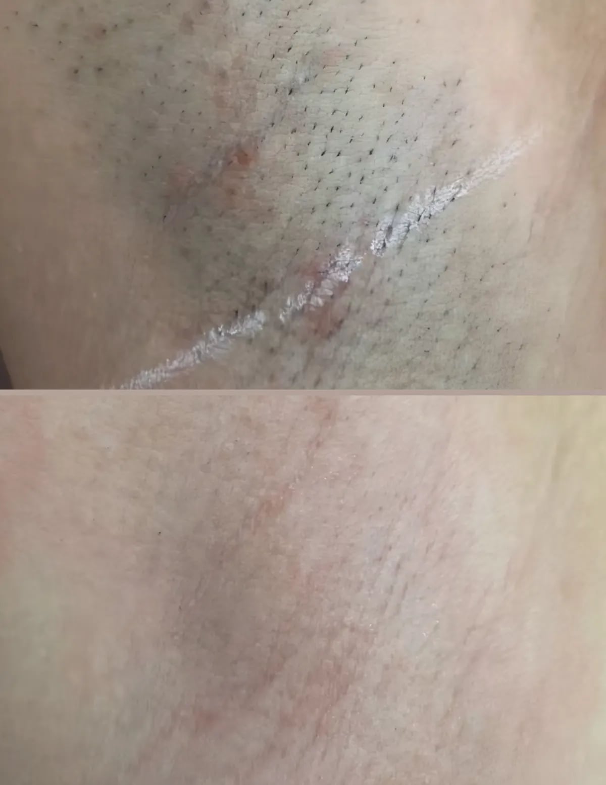 Close-up before and after: stubble above, smooth hair-free skin below